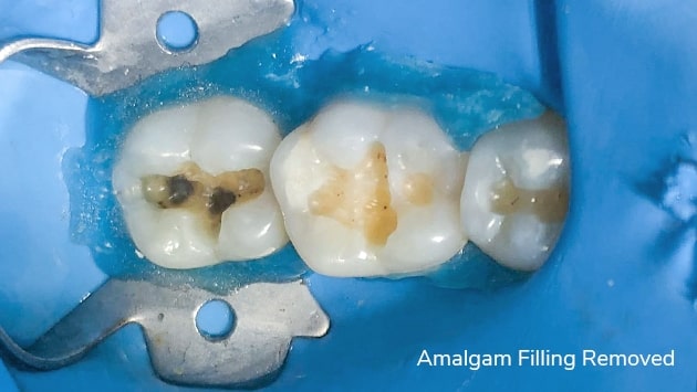 Teeth Amalgam Removal at Xdentistry