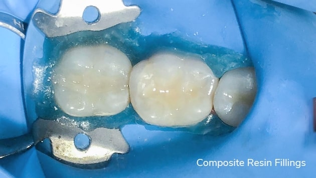 Composite Resin Filling