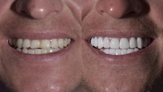 x dentistry cosmetic dentistry before after patient 01