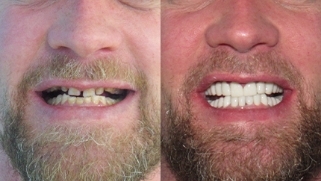 x dentistry cosmetic dentistry before after patient 04
