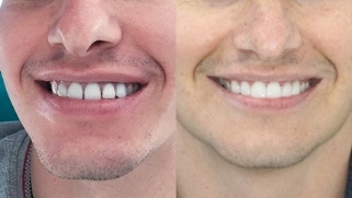 x dentistry cosmetic dentistry before after patient 06