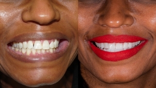 x dentistry cosmetic dentistry before after patient 15