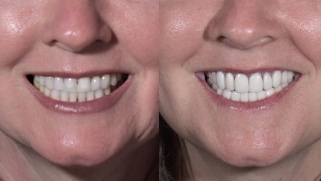 x dentistry cosmetic dentistry before after patient 16