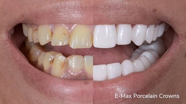 x dentistry crowns before after 01