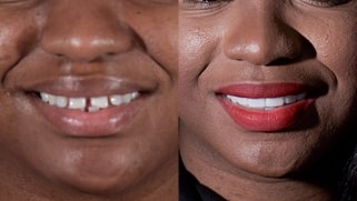 x dentistry crowns before after 01