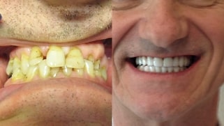 x dentistry crowns before after 02