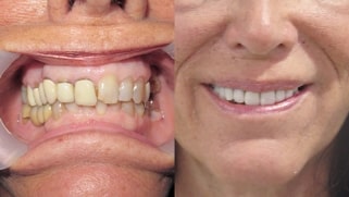 x dentistry crowns before after 03
