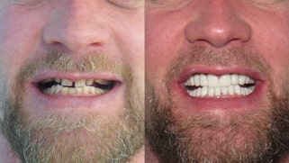 x dentistry crowns before after 04