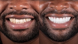 x dentistry crowns before after 05