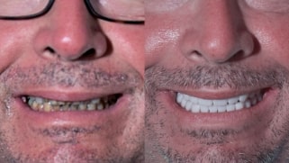 x dentistry crowns before after 10