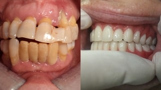 x dentistry full mouth reconstruction before after 01
