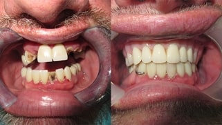 x dentistry full mouth reconstruction before after 02