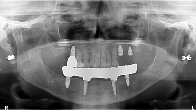x dentistry implant panoramic x ray 02
