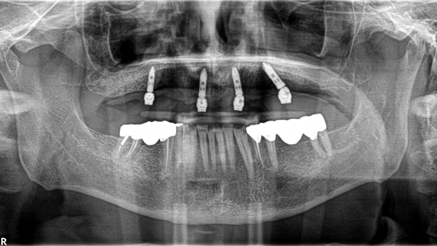 x dentistry implant panoramic x ray 03