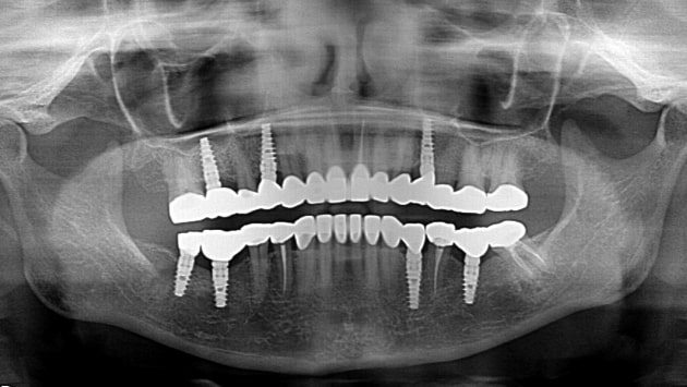 x dentistry implant panoramic x ray 04