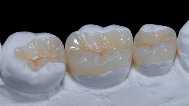 x dentistry inlay onlay model