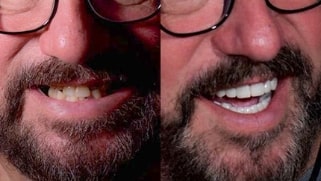 x dentistry patient before after implants 02