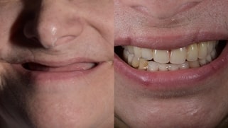 x dentistry patient before after implants 04
