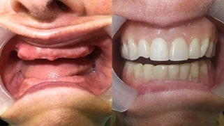 x dentistry patient before after implants 05