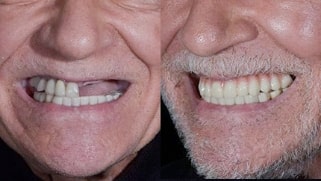 x dentistry patient before after implants 06
