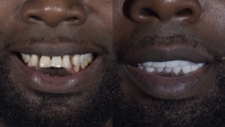 x dentistry patient before after implants 07