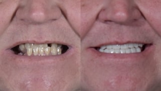 x dentistry patient before after implants 09