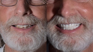 x-dentistry-restorative dentistry before after patient 06