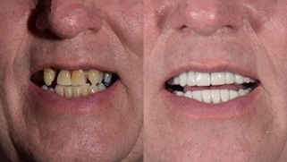 x-dentistry-restorative dentistry before after patient 10
