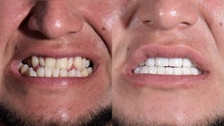 x-dentistry-restorative dentistry before after patient 12