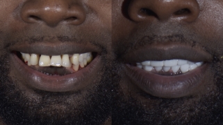 x-dentistry-restorative dentistry before after patient 13