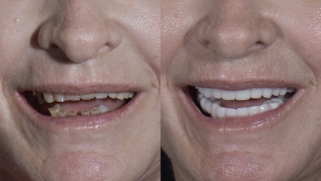 x-dentistry-restorative dentistry before after patient 14