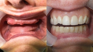 x-dentistry-restorative dentistry before after patient 16