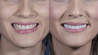 x dentistry smile makeover before after 02