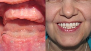 x dentistry snap on denture patient before after 01