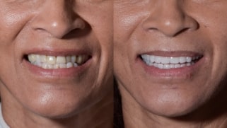 x dentistry snap on denture patient before after 05