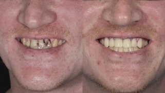 x dentistry snap on denture patient before after 08