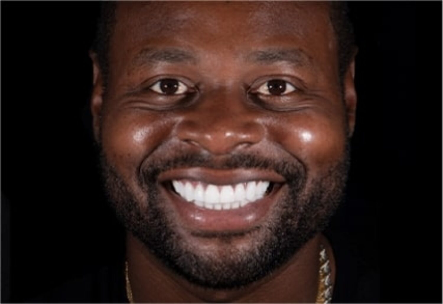 x dentistry teeth whitening patient after price 02