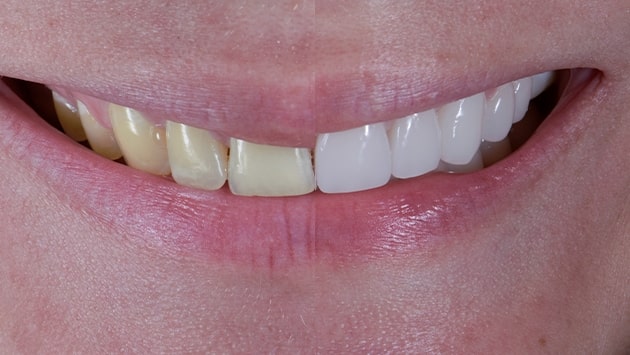 x dentistry teeth whitening patient before after 01