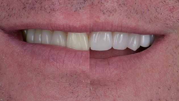 x dentistry teeth whitening patient before after 02