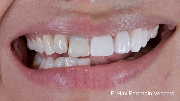 x dentistry veneers before after 01