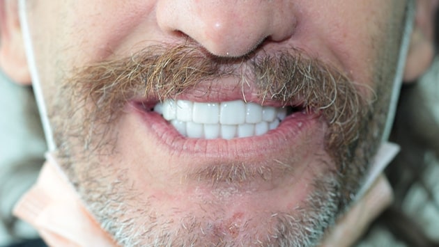 x dentistry whitening before after 01