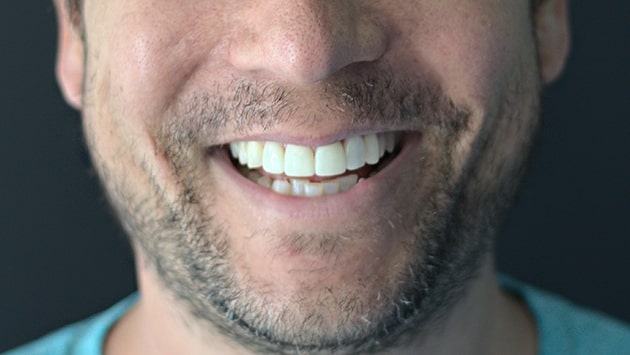 x dentistry whitening before after 02