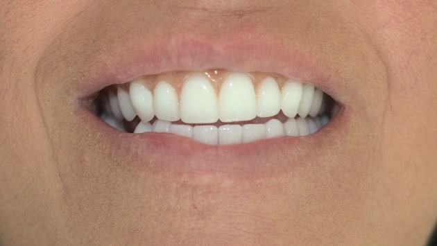 x dentistry whitening before after 03