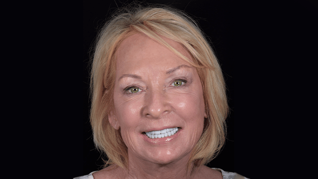 xdentistry all on 4 patient 04