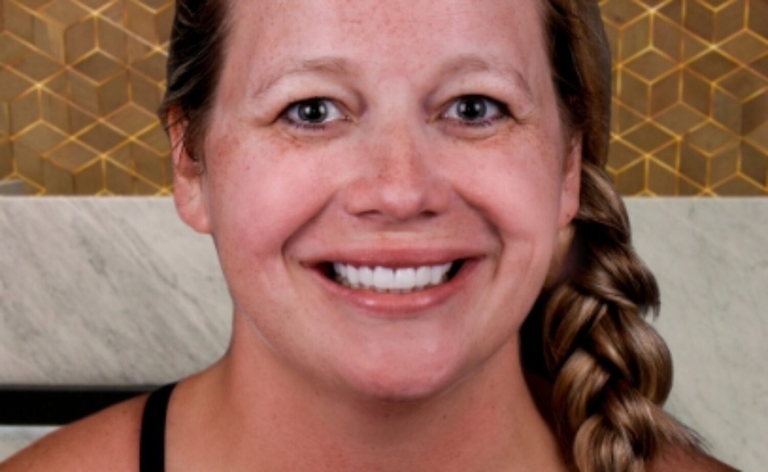 smile makeover dental veneers tijuana