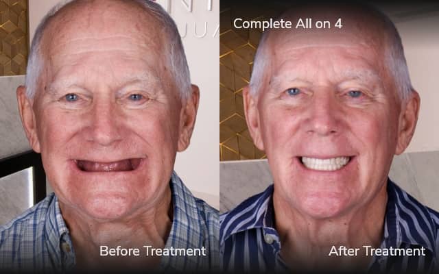 before after all on 4 tijuana xdentistry 01