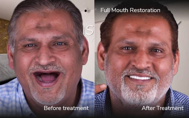 before after all on 4 tijuana xdentistry 02