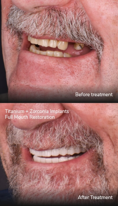 before after all on 4 tijuana xdentistry