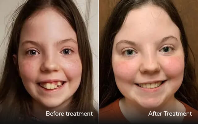 before after invisalign tijuana cost 01