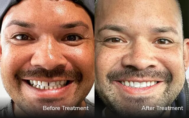 before after invisalign tijuana cost 02